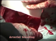 Hemo-Fiber: arterial hemostasis 